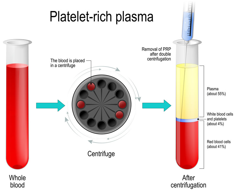 The Power of RF Microneedling with PRP Combination Treatments