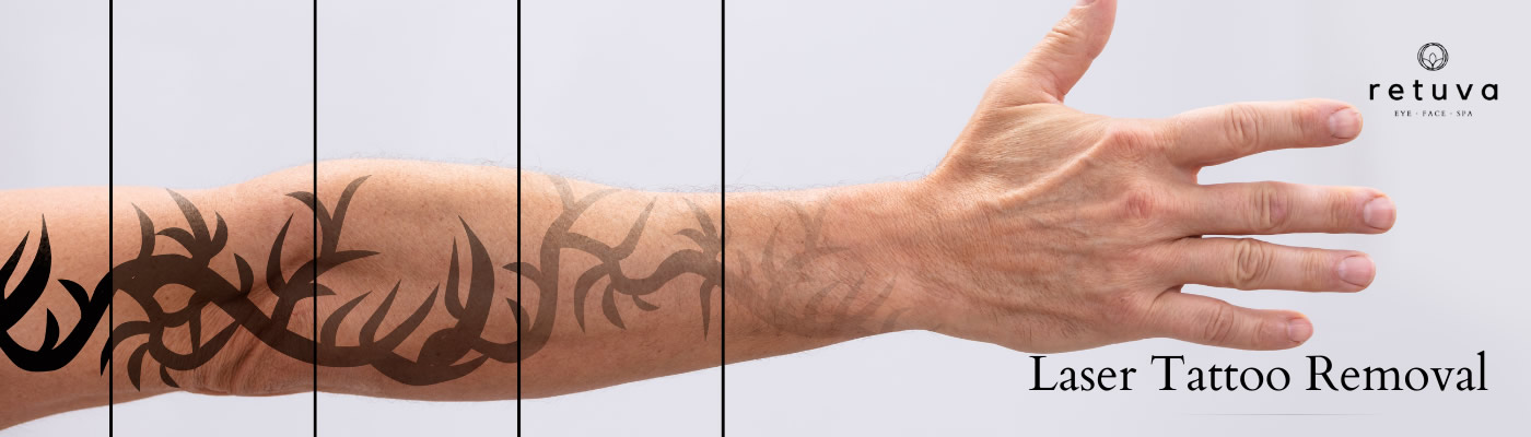 Laser Tattoo Removal  Enlighten Latest and Most Effective  TechnologyFastest ResultsHartford CT